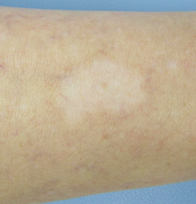 尋常性白斑 お知らせ 高木皮膚科 漢方皮膚科 尋常性白斑 お知らせ 高木皮膚科 漢方皮膚科